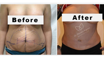 tummy-patient2